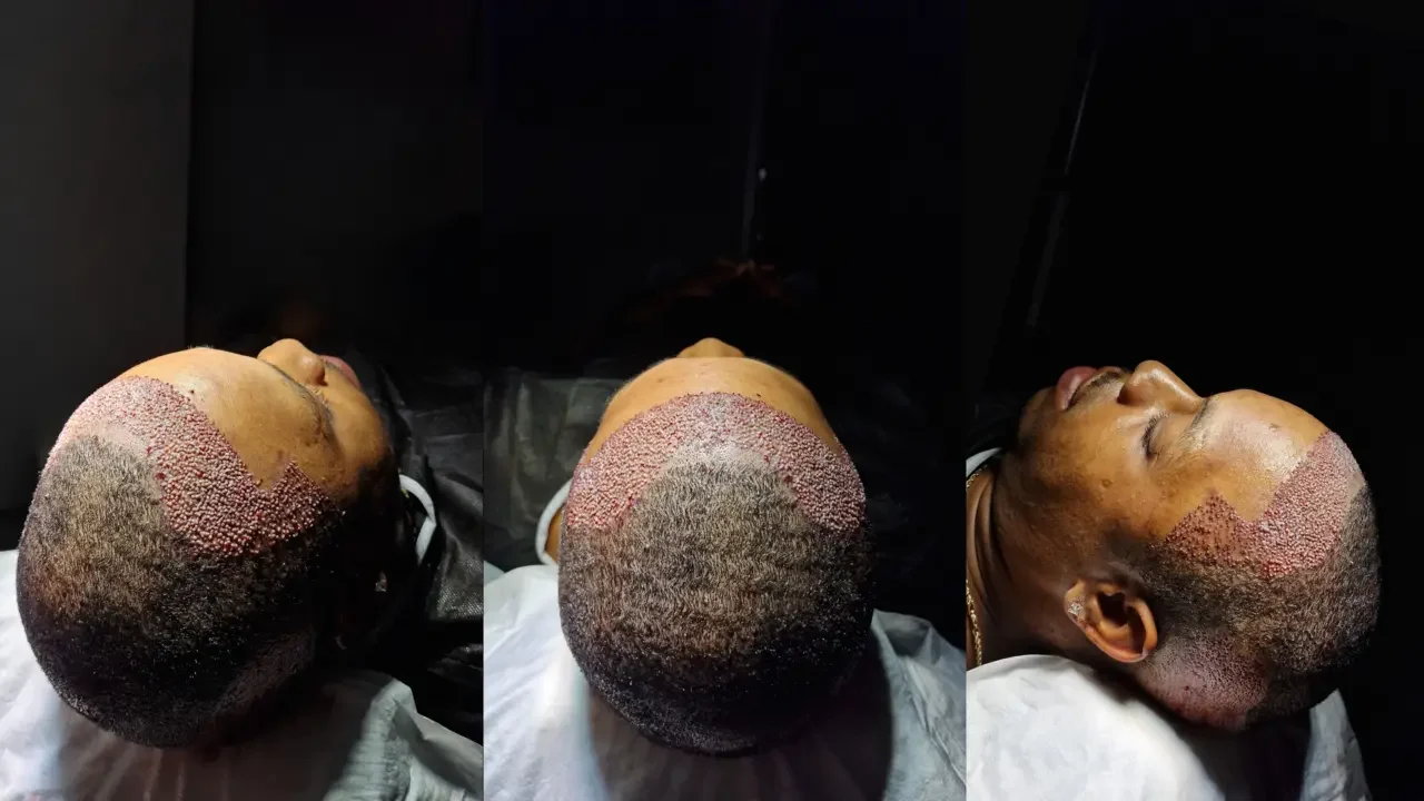 afro hair transplant operation in turkey