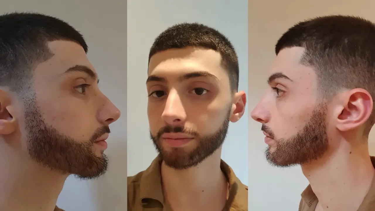 beard transplant after