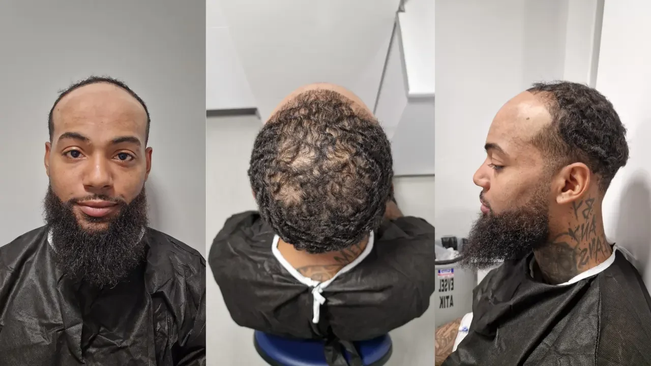 before afro hair transplant