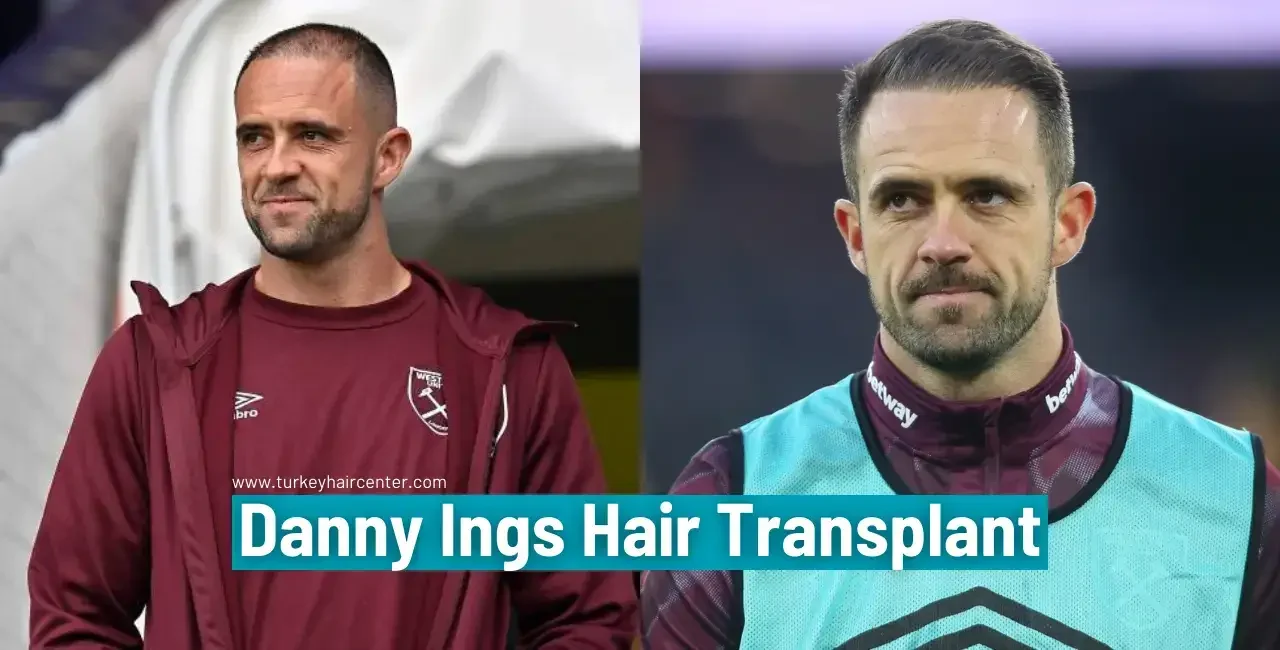 Danny Ings Hair Transplant