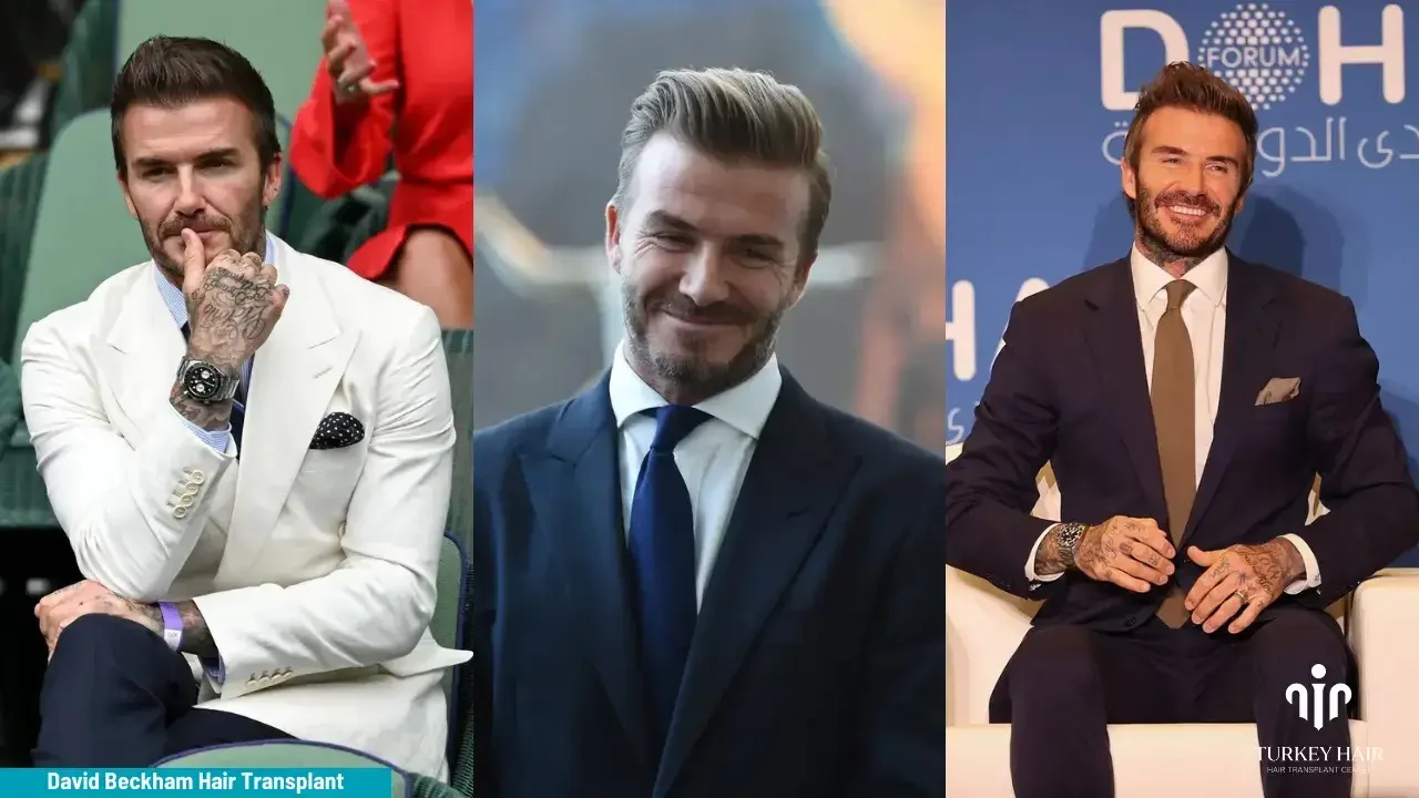 David Beckham Hair Transplant