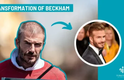David Beckham Hair Transplant