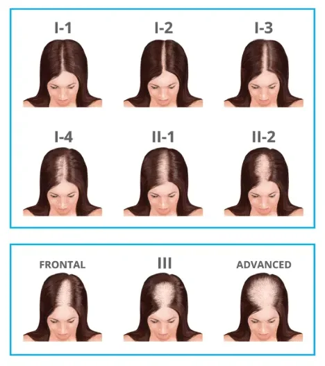 hair loss stages in women