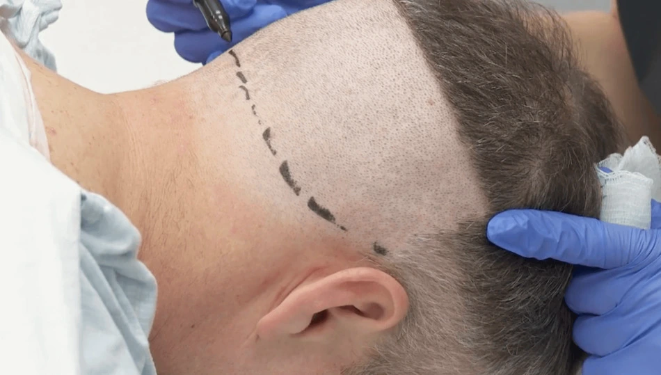 What is the Donor Area in FUE Transplantation?