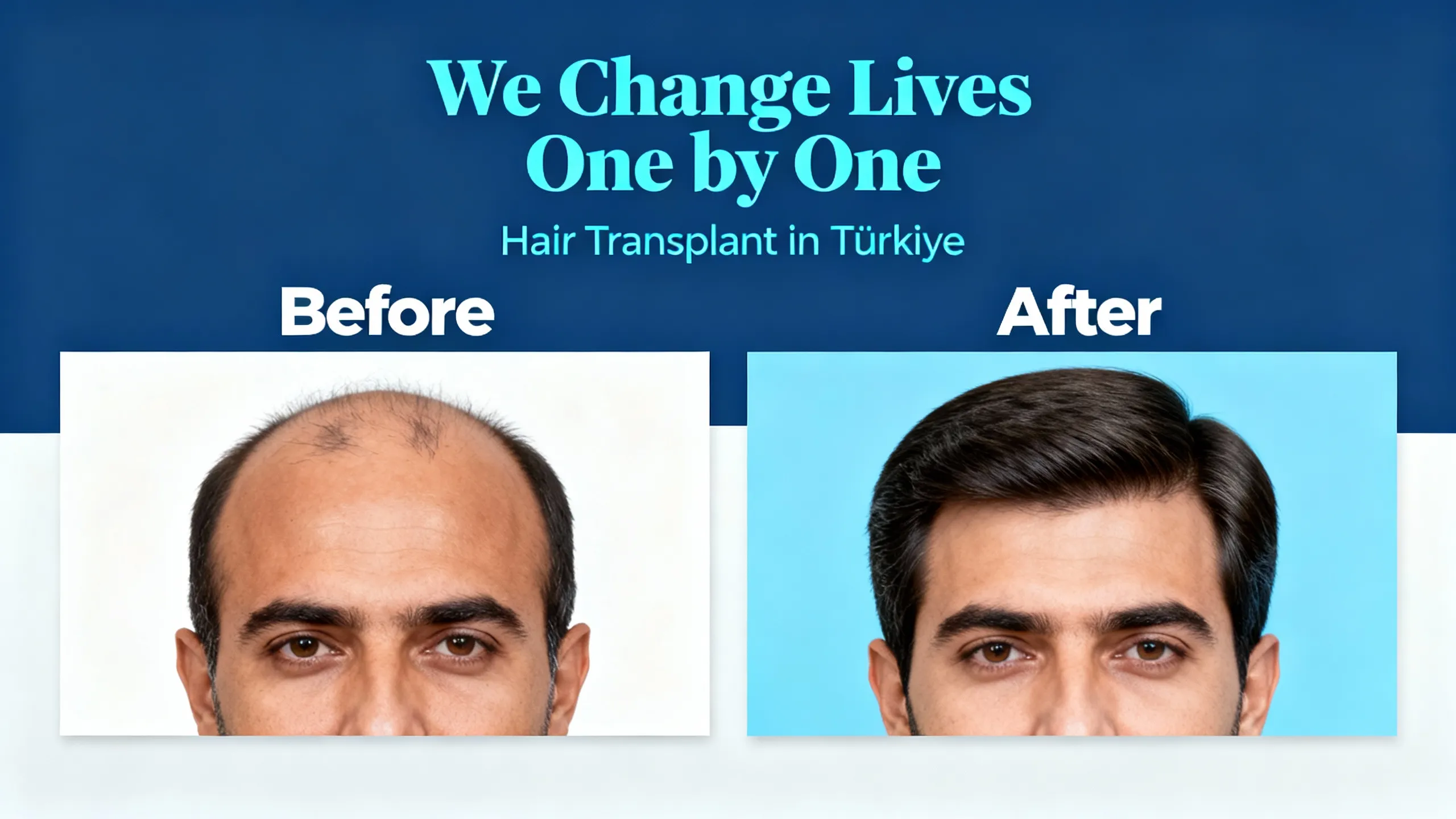 Hair Transplant Packages Hair Transplant Packages