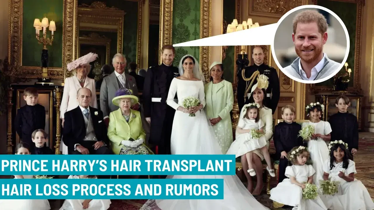 prince harry hair transplant