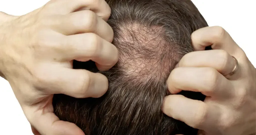side effects of minoxidil on hair transplant surgery 3 1024x5401 1 1