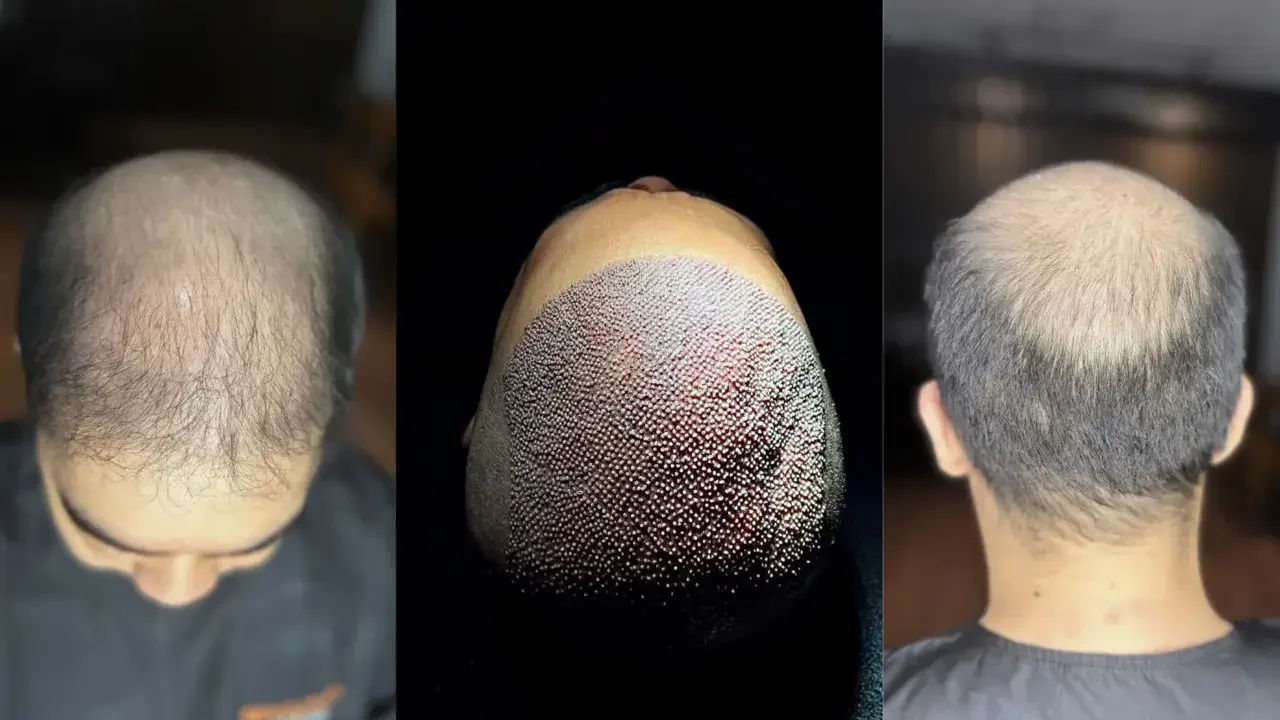 turkey hair transplant before and after04