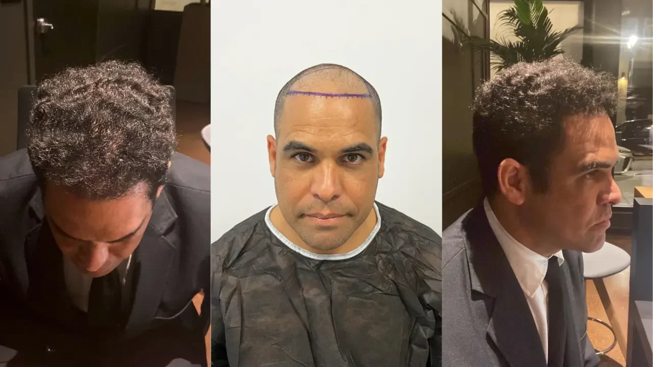 turkey hair transplant before and after05