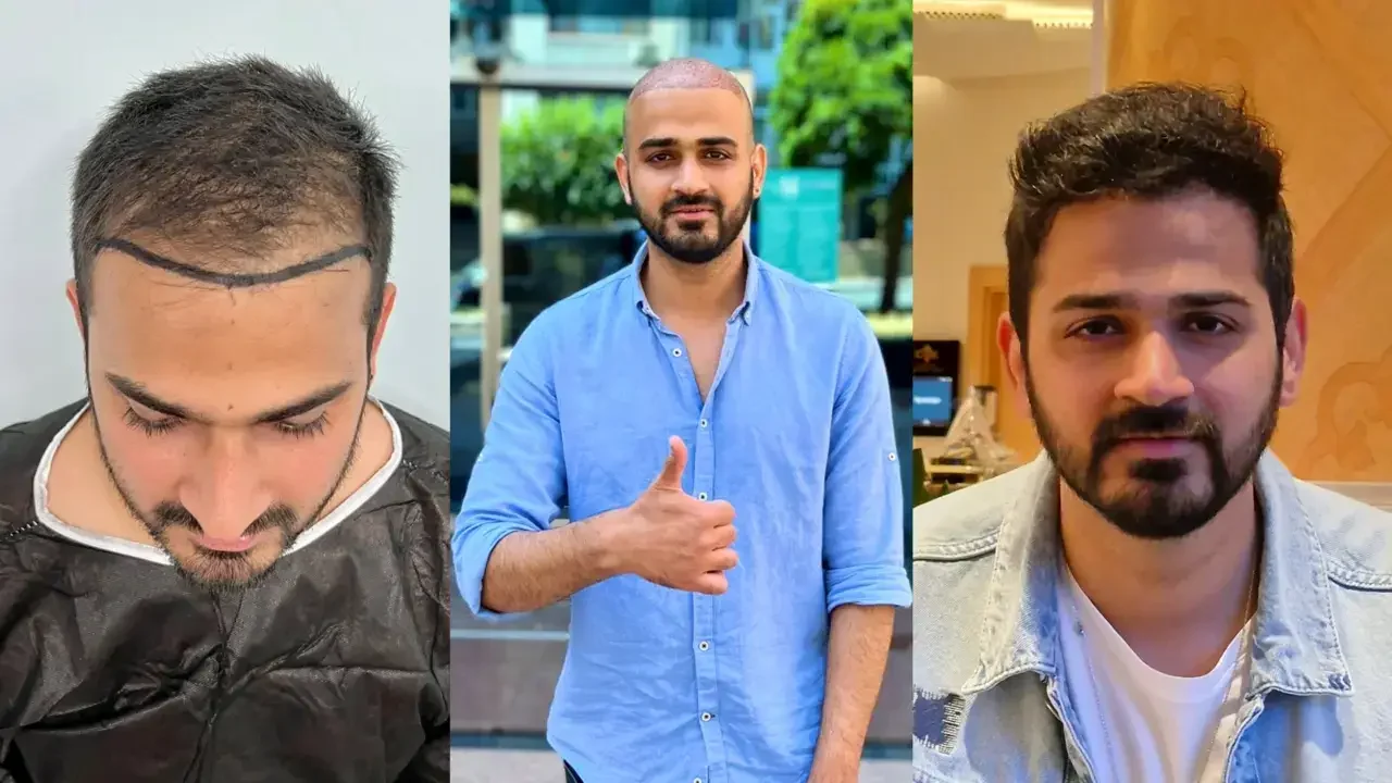 turkey hair transplant before and after07 1