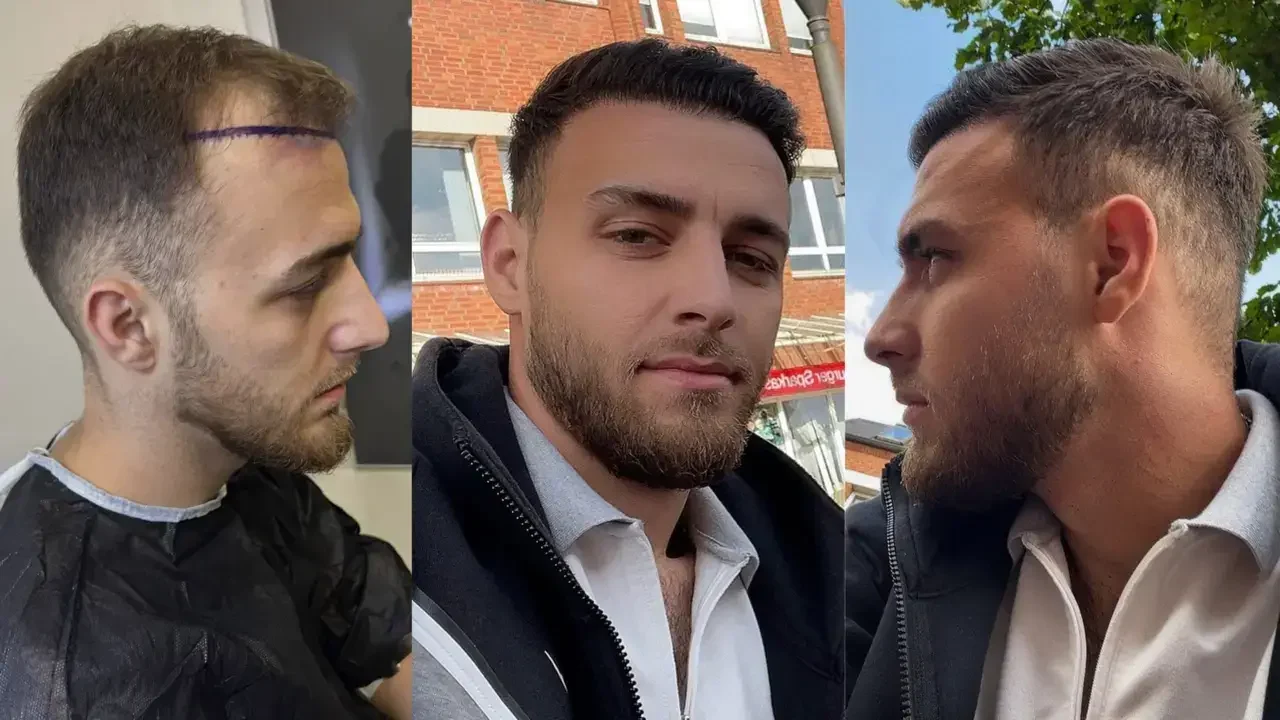 turkey hair transplant before and after11