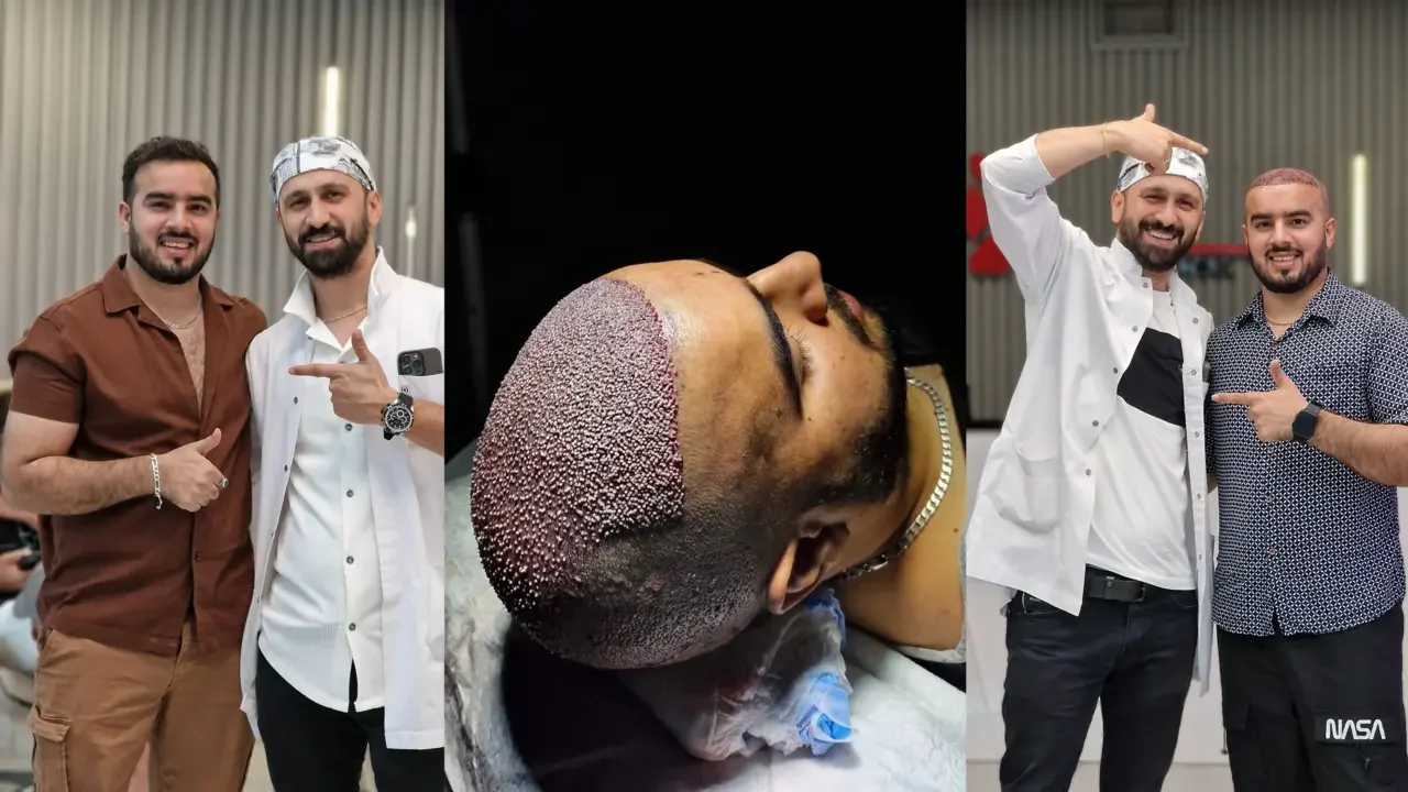 turkey hair transplant before and after12