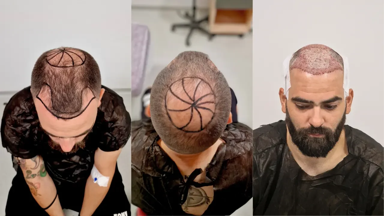 turkey hair transplant operation before and after