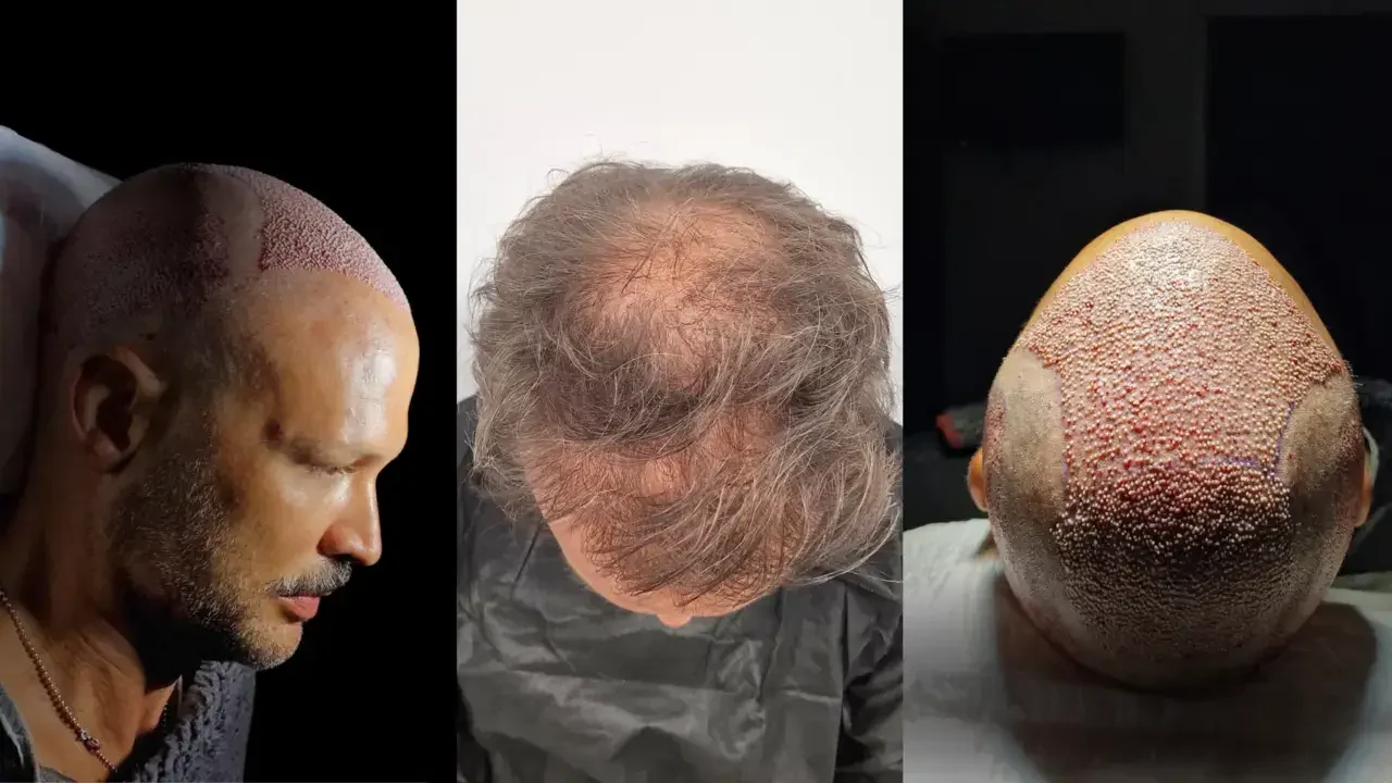 turkey hair transplant world record3