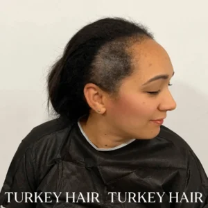 women hair transplant in turkey2 300x300 1