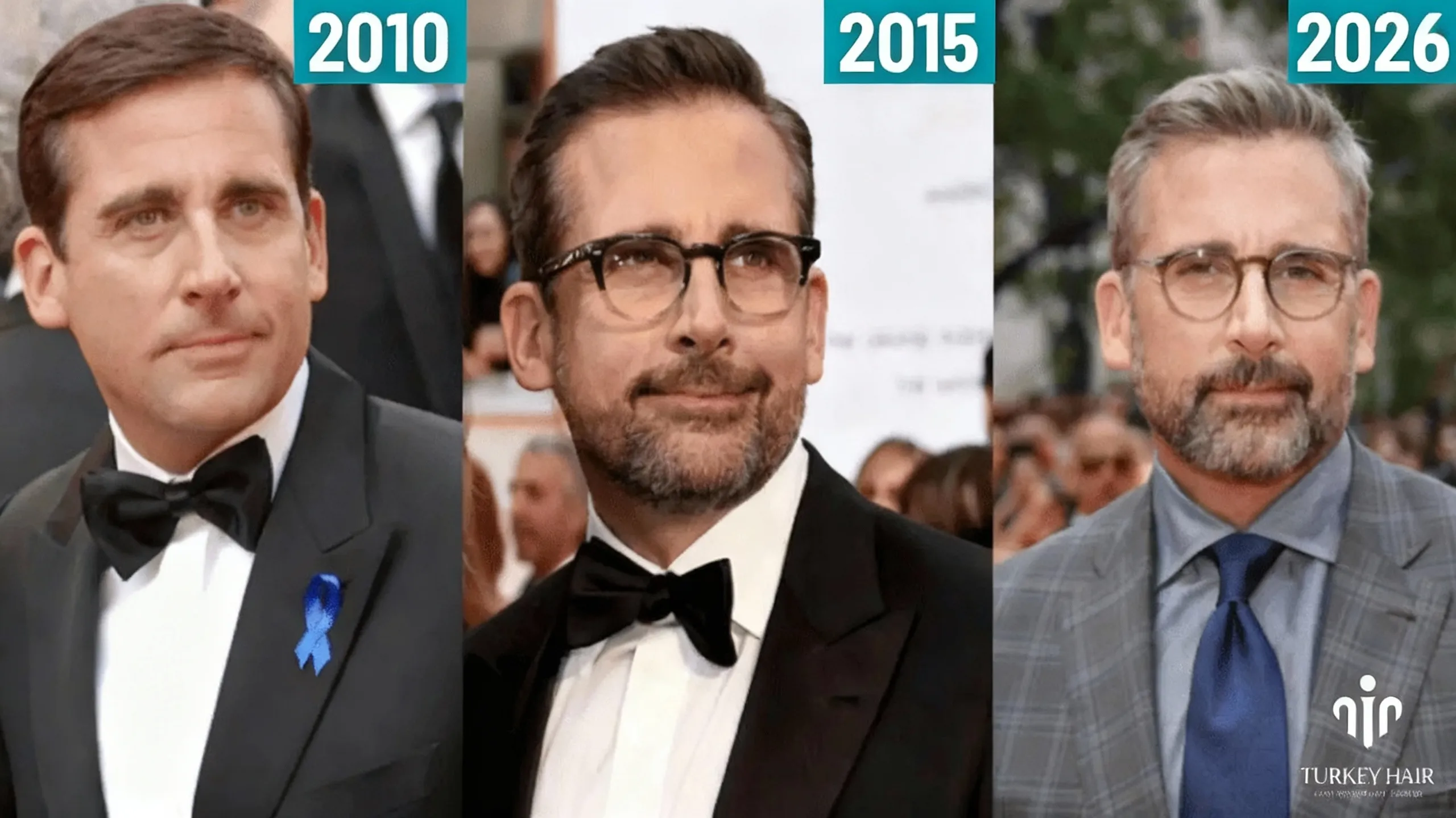 Steve Carell’s Hair Transplant