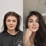 Female Hair Transplant Before And After Female Hair Transplant Before And After