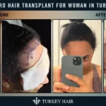 Afro Hair Transplant For Women