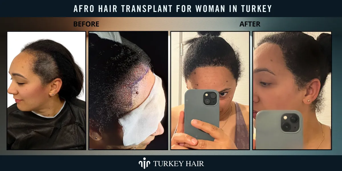 Afro Hair Transplant 22 Afro Hair Transplant For Women