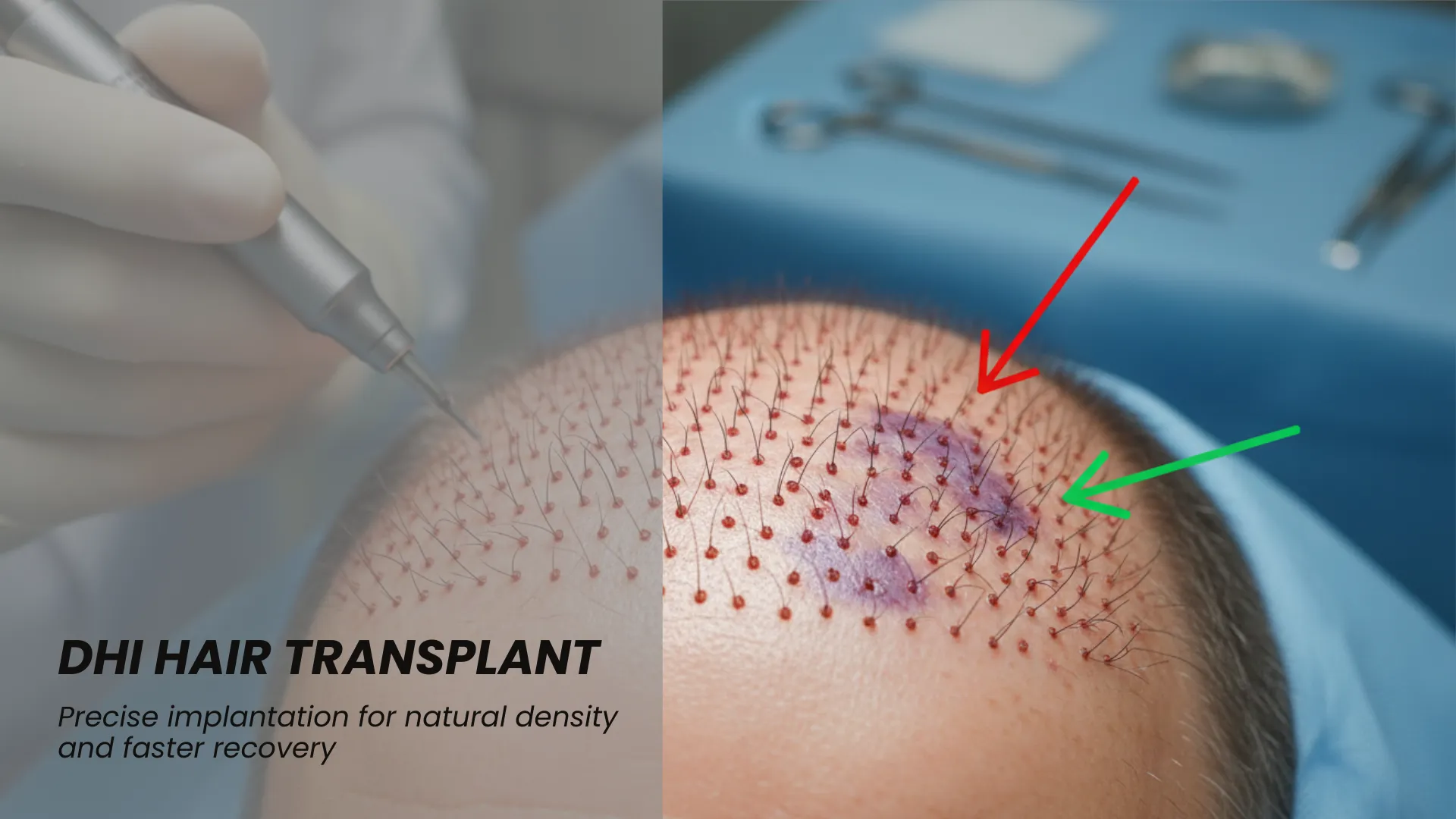 Dhi Hair Transplant