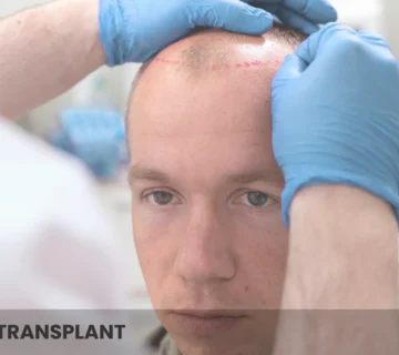 Dhi Hair Transplant