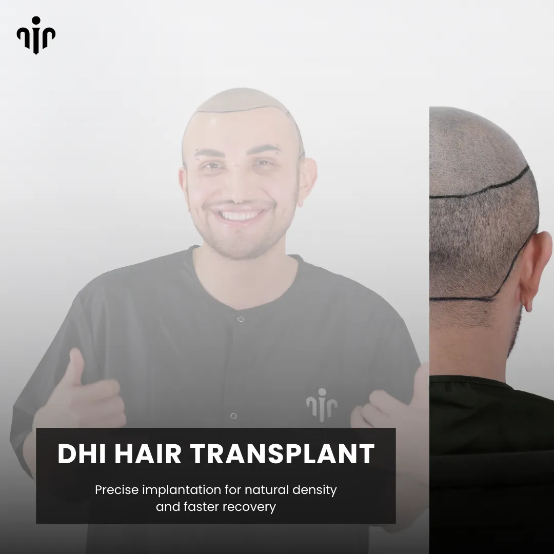 Direct Hair Implantation