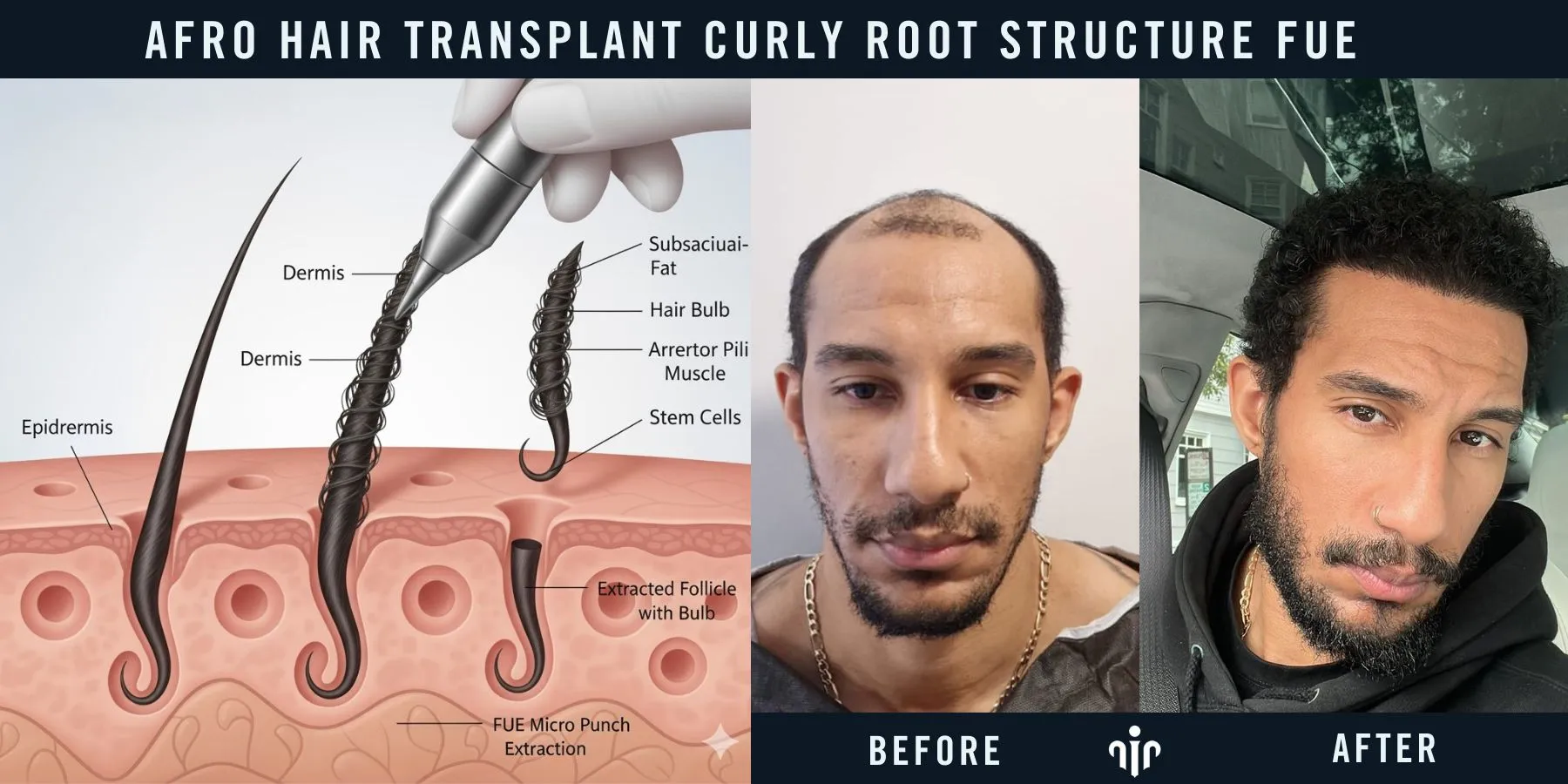 Afro Hair Transplant 21 Donor Area Management For Curly And Coily Hair