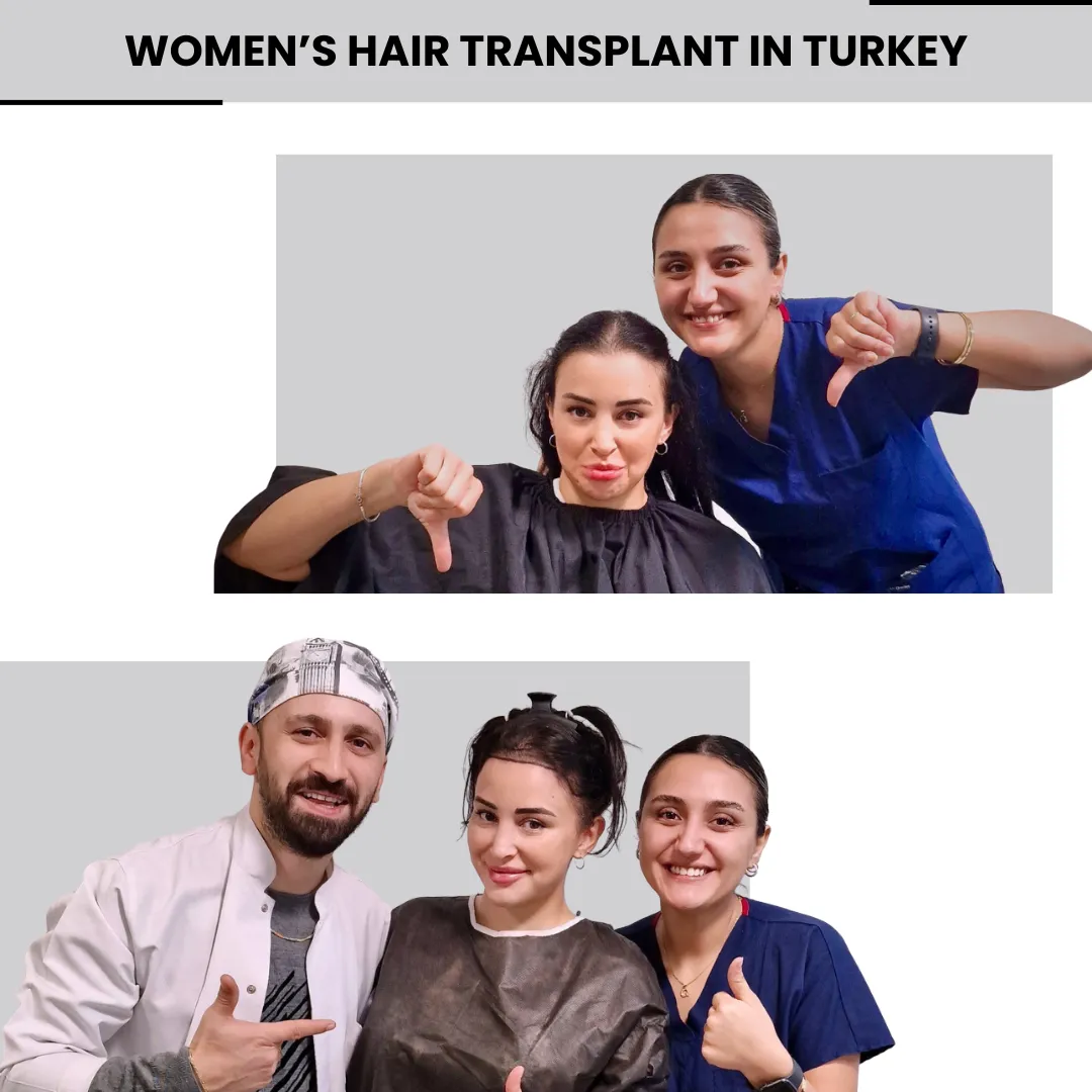 Hair Transplant Techniques Used For Female