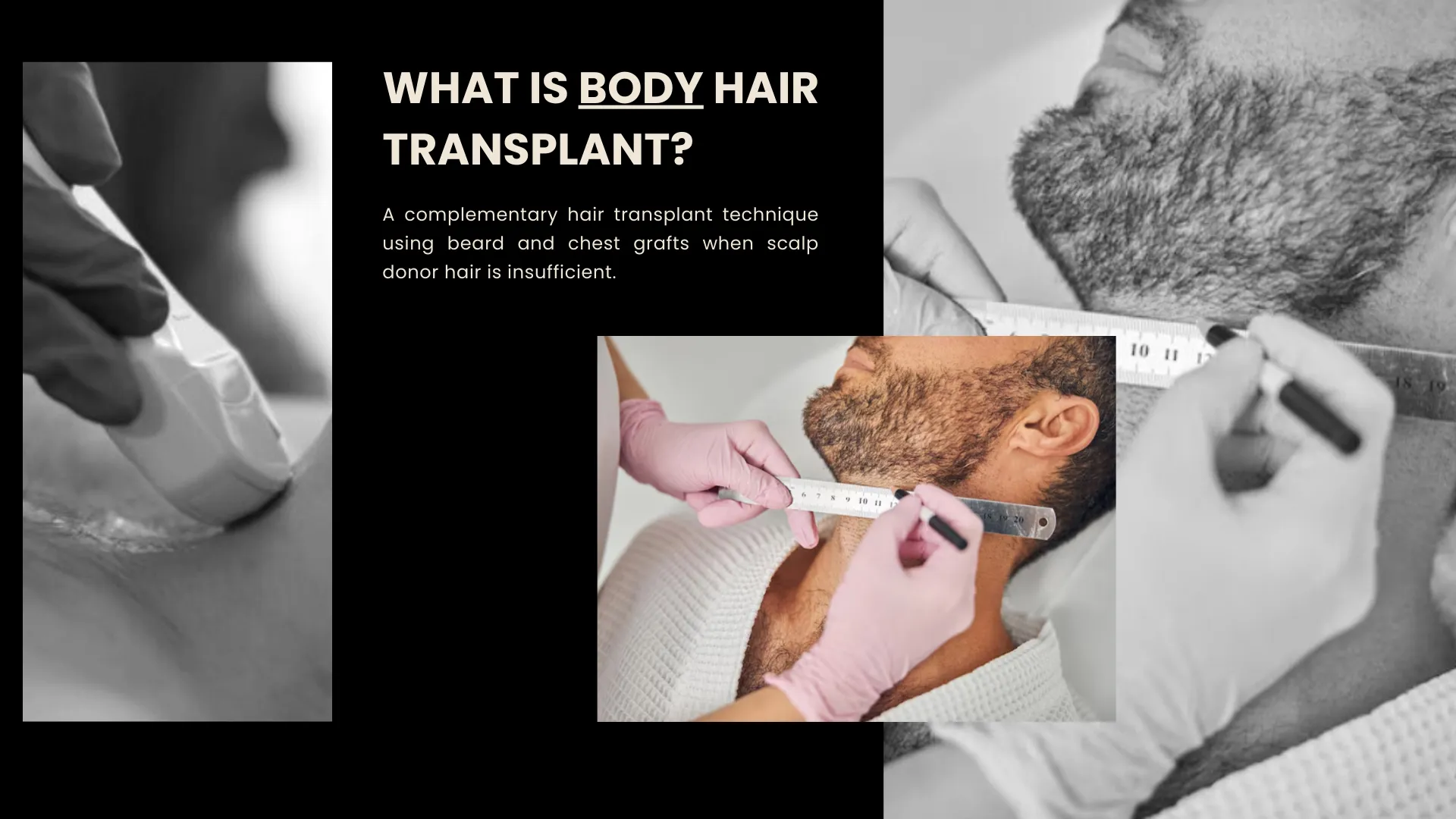 Body Hair Transplant 8 How Body Hair Transplant Works
