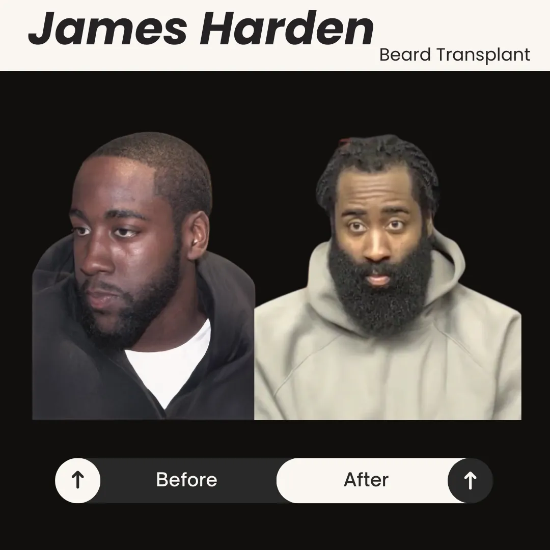 James Harden Beard Transplant Before And After