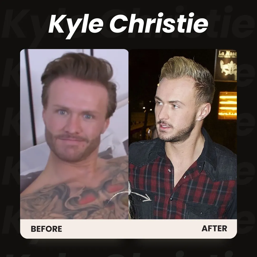 Kyle Christie Beard Transplant Before And After