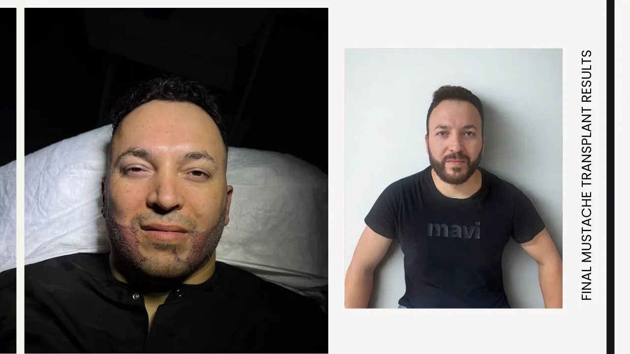 Mustache Transplant Before &Amp; After