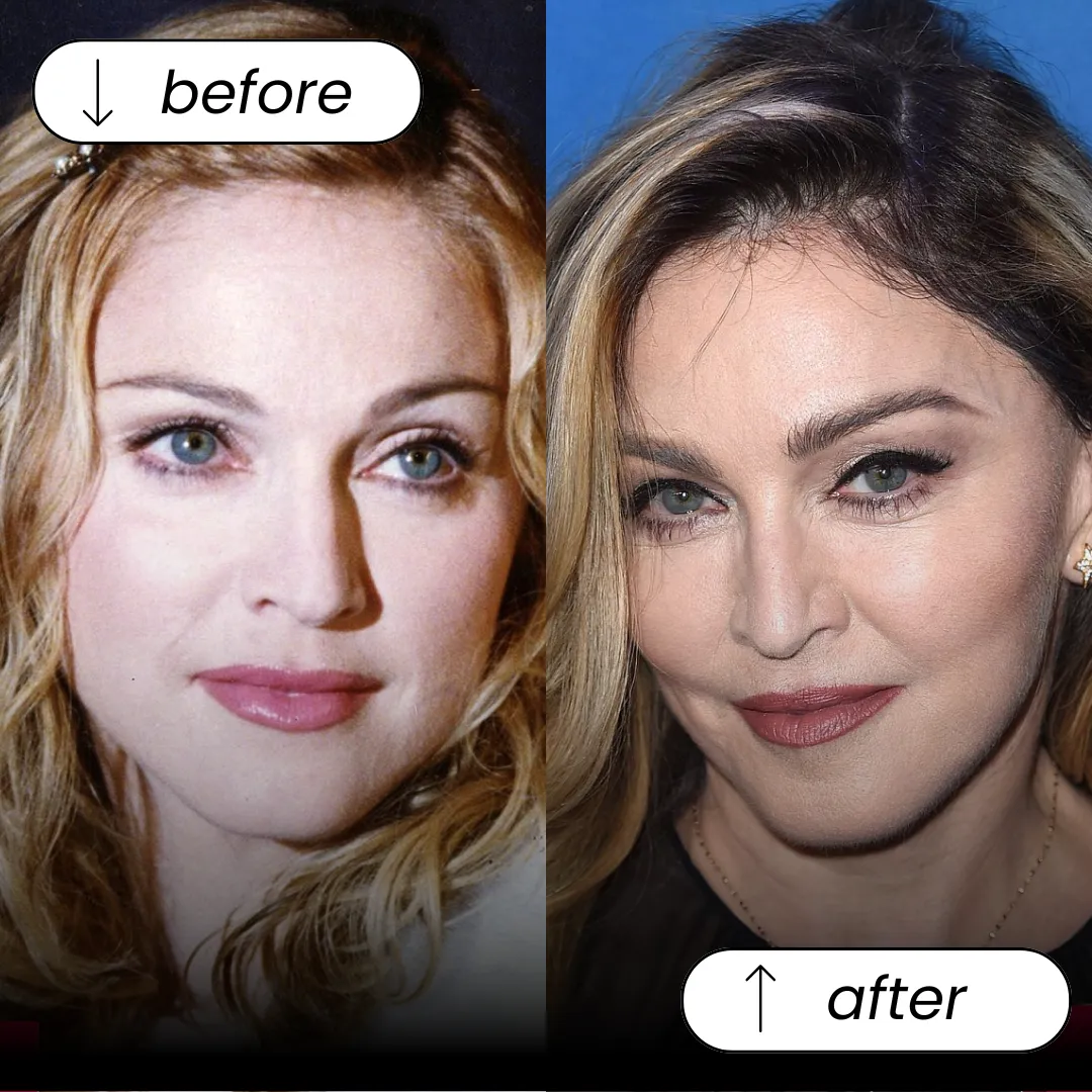 Natural Eyebrow Transplant