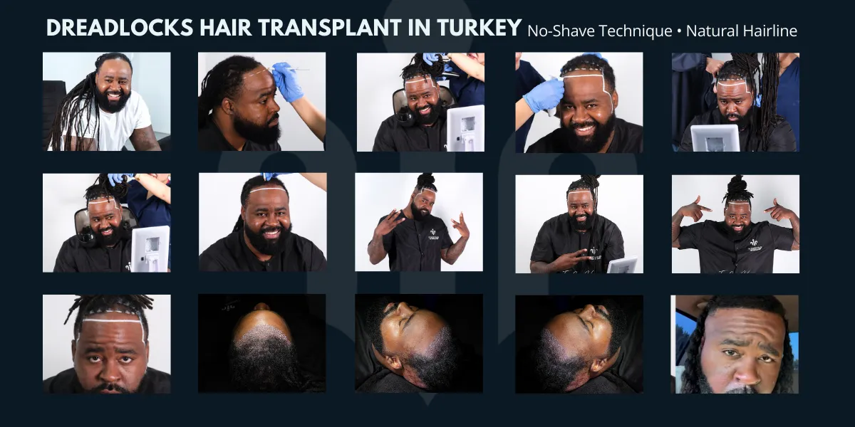 Afro Hair Transplant 23 Non-Shaven And Dhi Options