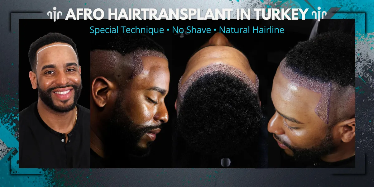 Afro Hair Transplant 18 Hair Transplant Techniques For Afro Hair