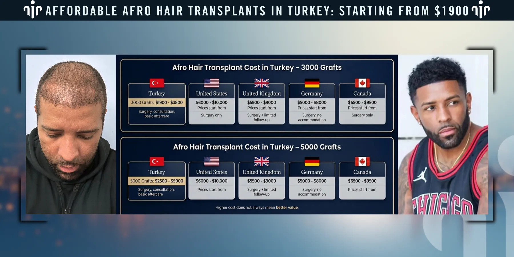 Afro Hair Transplant 13 Afro Hair Transplant Cost In Turkey