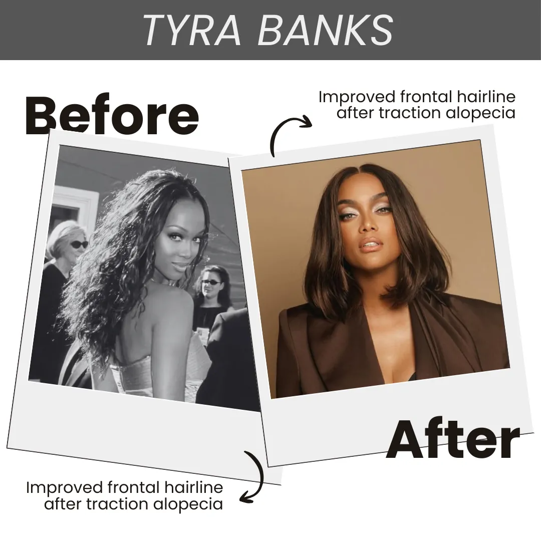 Tyra Banks Before And After The Hair Transplant