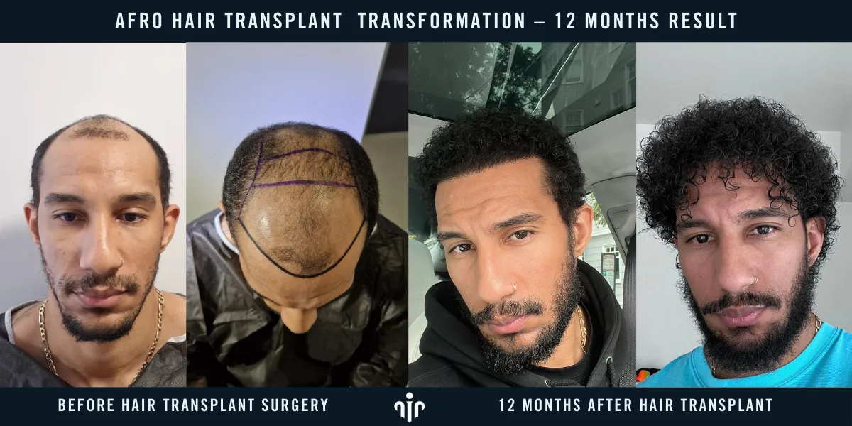 Afro Hair Transplant 16 Verified Patient Transformations