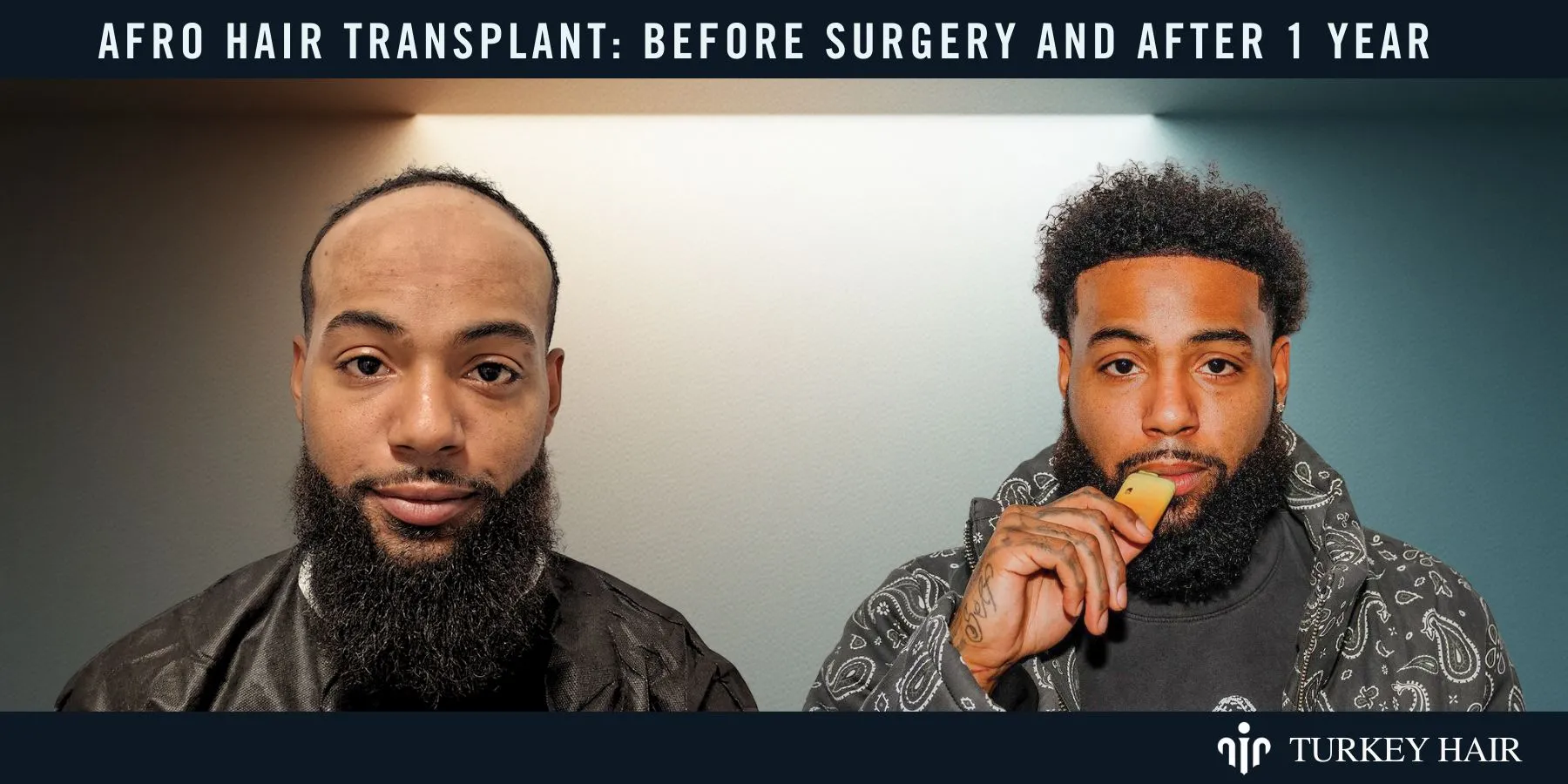 Afro Hair Transplant 15 What Realistic Afro Hair Transplant Results