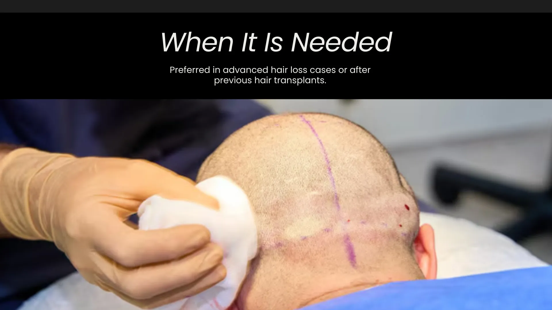 Body Hair Transplant 7 When Donor Hair