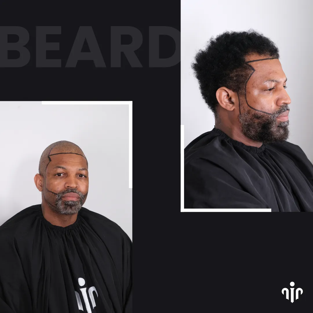 Beard Transplant 