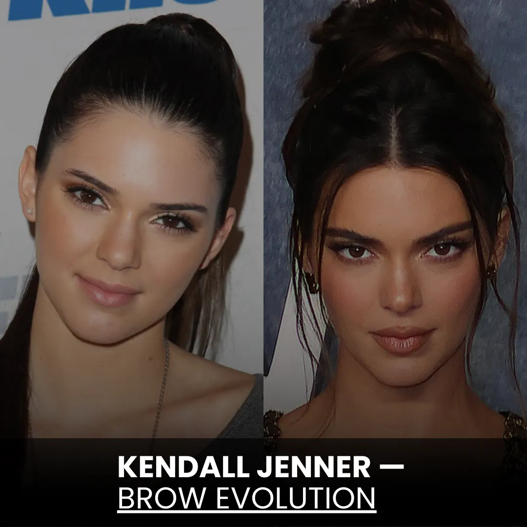 Before And After Eyebrow Transplant