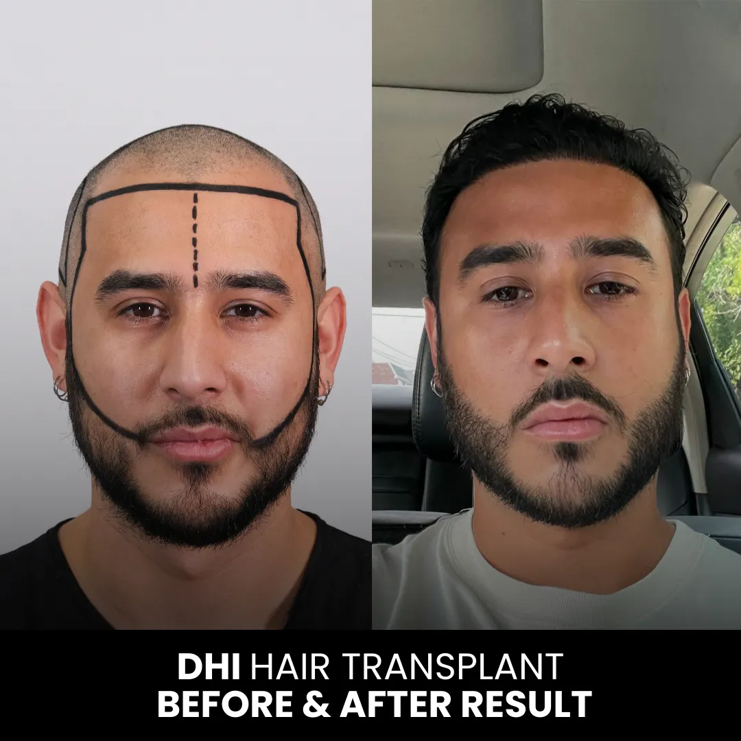Dhi Hair Transplant Before And After