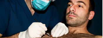 Body Hair Transplant