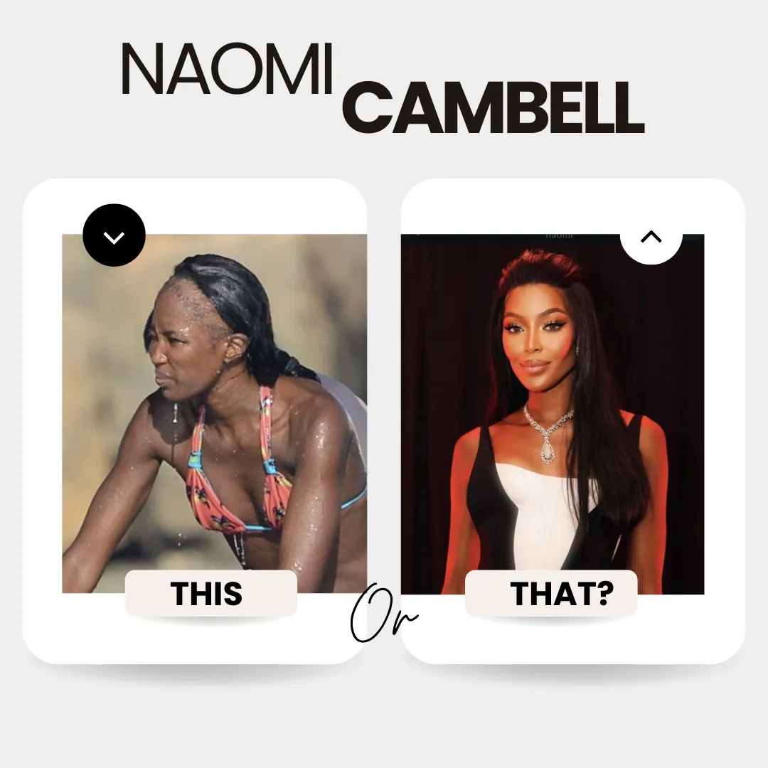 Naomi Campbell Before And After The Hair Transplant 