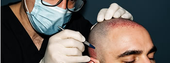 Sapphire Hair Transplant