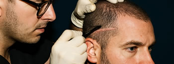 Scar Hair Transplant