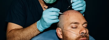 Sedated Hair Transplant
