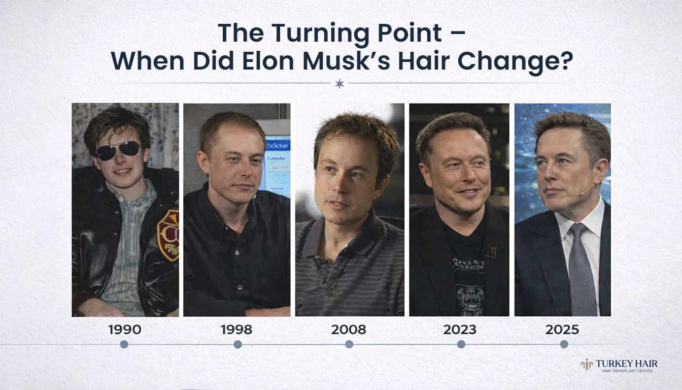 Elon Musk Hair Transplant Success Story: Before And After 2 Elon Musk'S Hair Transplant Journey
