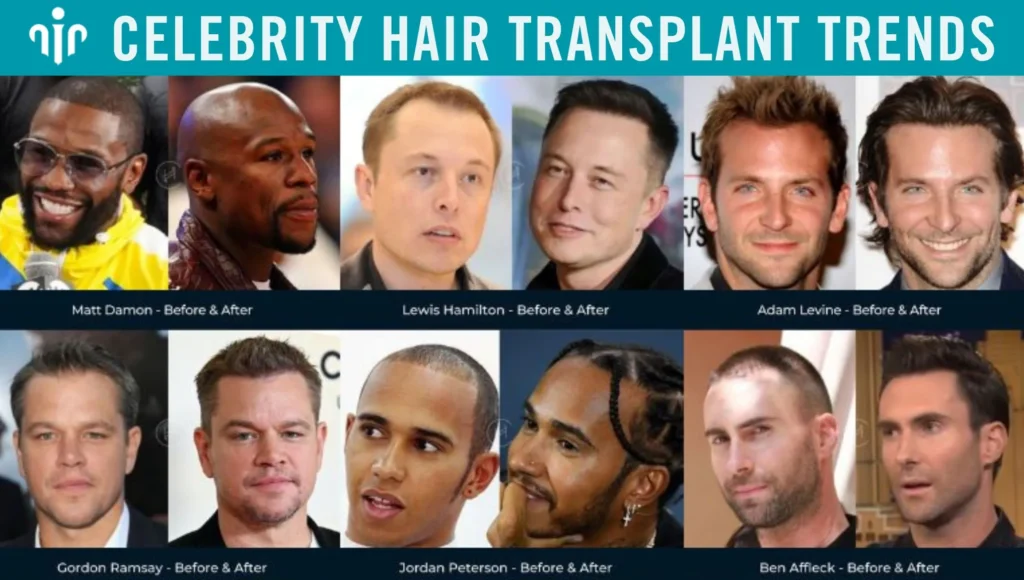 Celebrity-Hair-Transplant-Trends Celebrity-Hair-Transplant-Trends